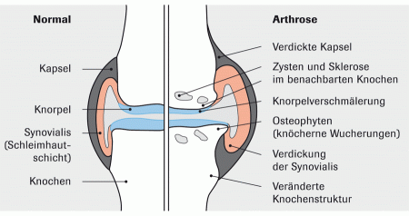 Arthrose